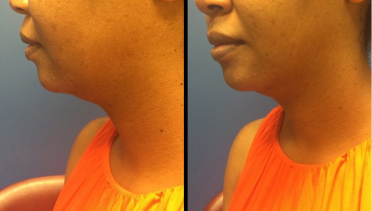 Chin and Neck Contouring Before & After