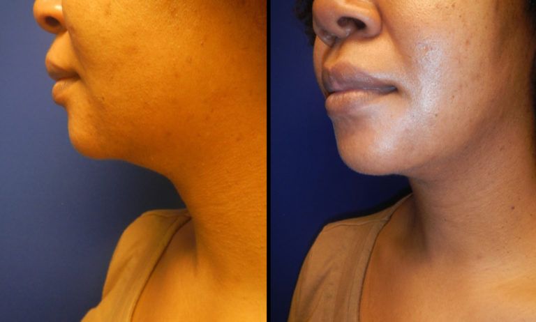 Chin and Neck Contouring Before & After