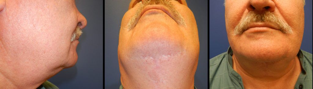 Chin and Neck Contouring Before & After