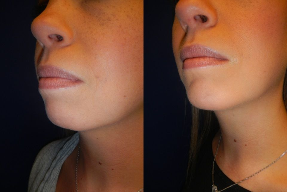 Chin and Neck Contouring Before & After