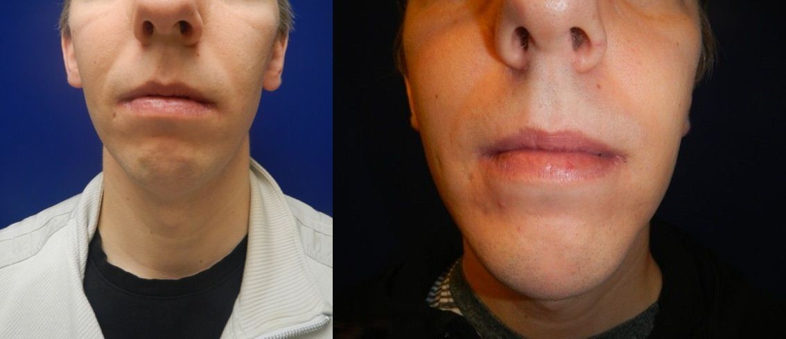 Chin and Neck Contouring Before & After