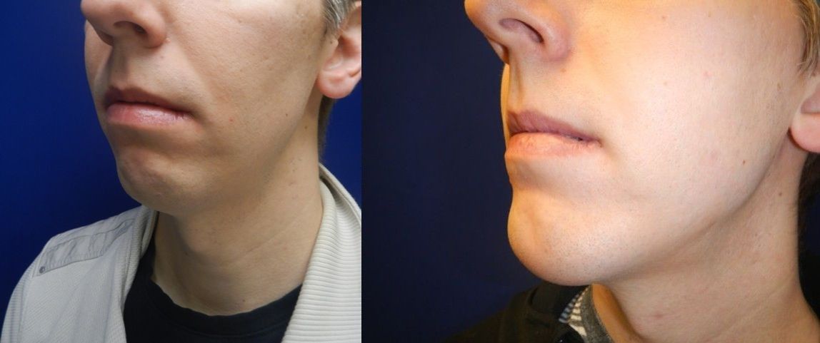 Chin and Neck Contouring Before & After