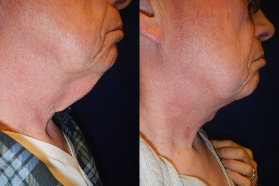 Chin and Neck Contouring Before & After