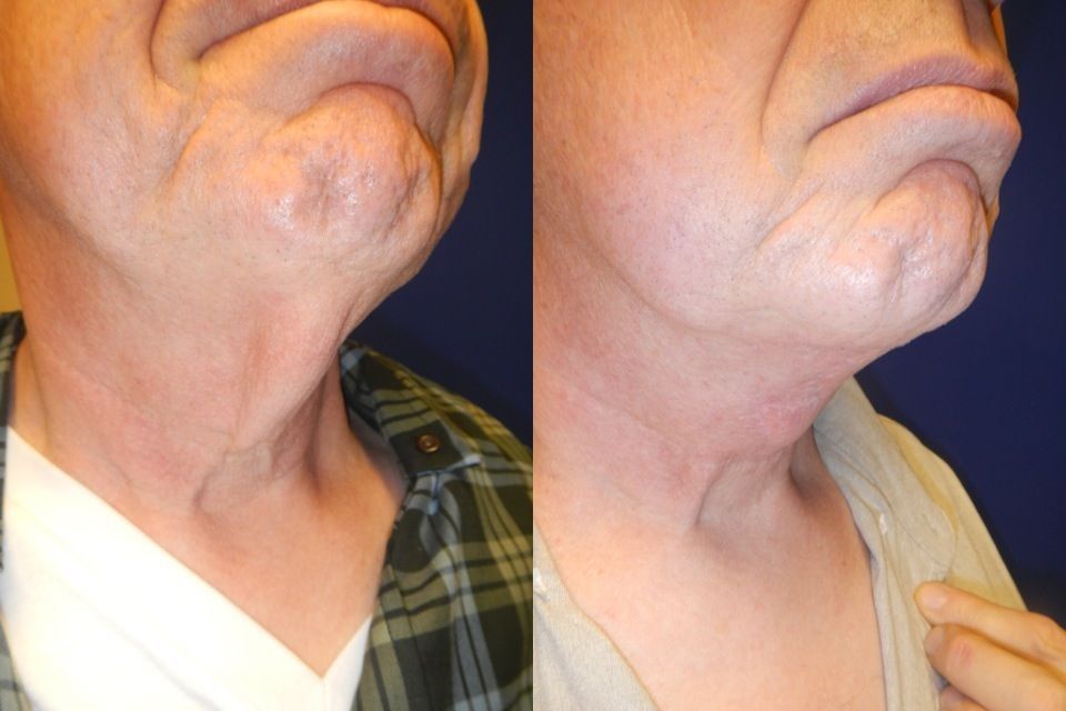Chin and Neck Contouring Before & After