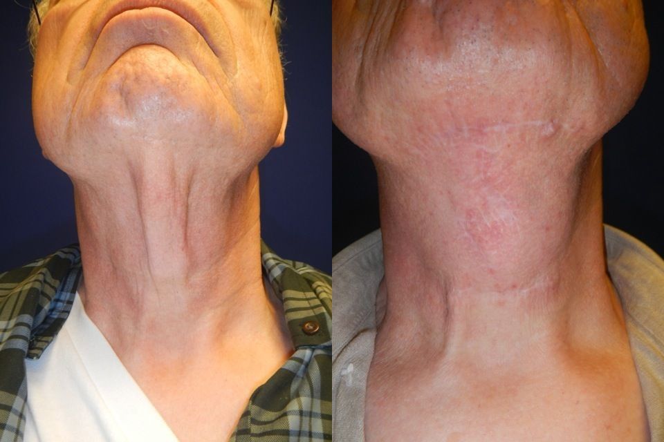 Chin and Neck Contouring Before & After