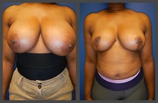 Breast Reduction Before & After