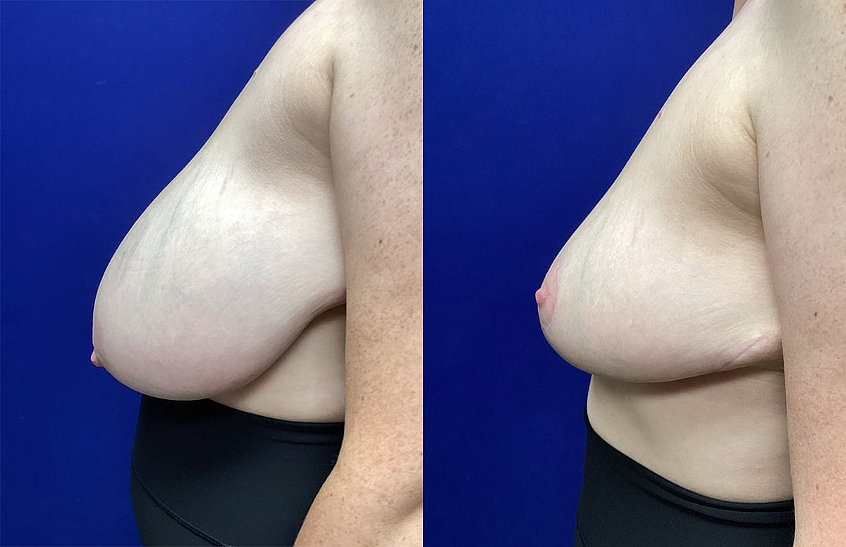 Before and after breast appearance comparison.