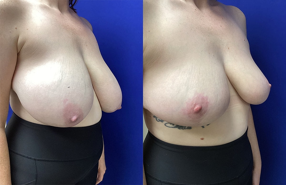 Before and after breast enhancement comparison.