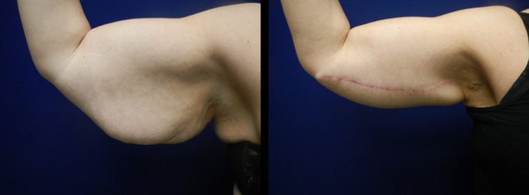 Arm Lift Gallery Before & After