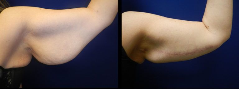 Arm Lift Gallery Before & After