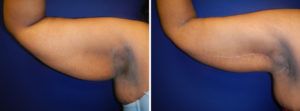 Arm Lift Gallery Before & After