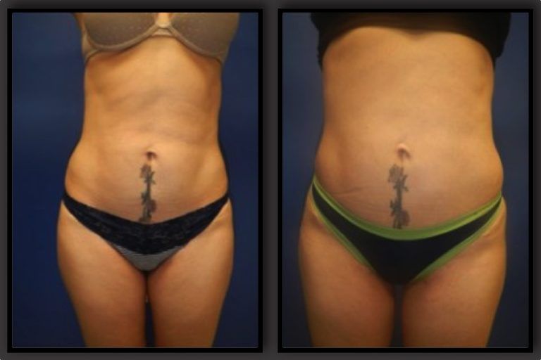 Brazilian Butt Lift Gallery Before & After