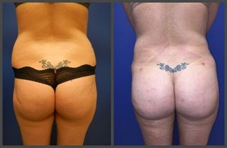 Brazilian Butt Lift Gallery Before & After