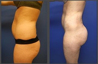 Brazilian Butt Lift Gallery Before & After