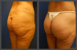 Brazilian Butt Lift Gallery Before & After