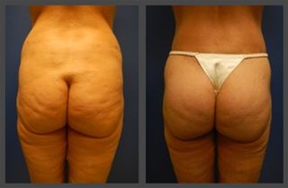 Brazilian Butt Lift Gallery Before & After