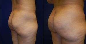 Brazilian Butt Lift Gallery Before & After
