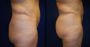 Brazilian Butt Lift Gallery Before & After