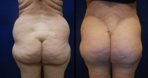 Brazilian Butt Lift Gallery Before & After