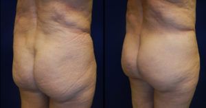 Brazilian Butt Lift Gallery Before & After