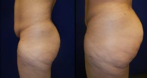 Brazilian Butt Lift Gallery Before & After