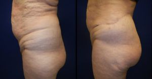 Brazilian Butt Lift Gallery Before & After