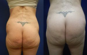 Brazilian Butt Lift Gallery Before & After