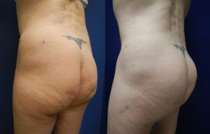 Brazilian Butt Lift Gallery Before & After