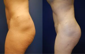 Brazilian Butt Lift Gallery Before & After