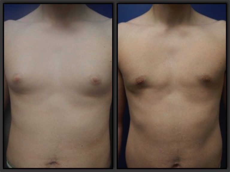 Male Breast Reduction Before & After