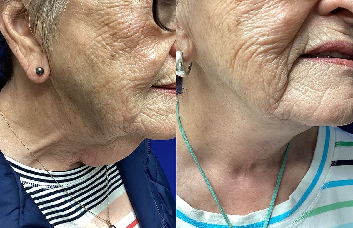 Close-up of elderly woman's neck and jawline.