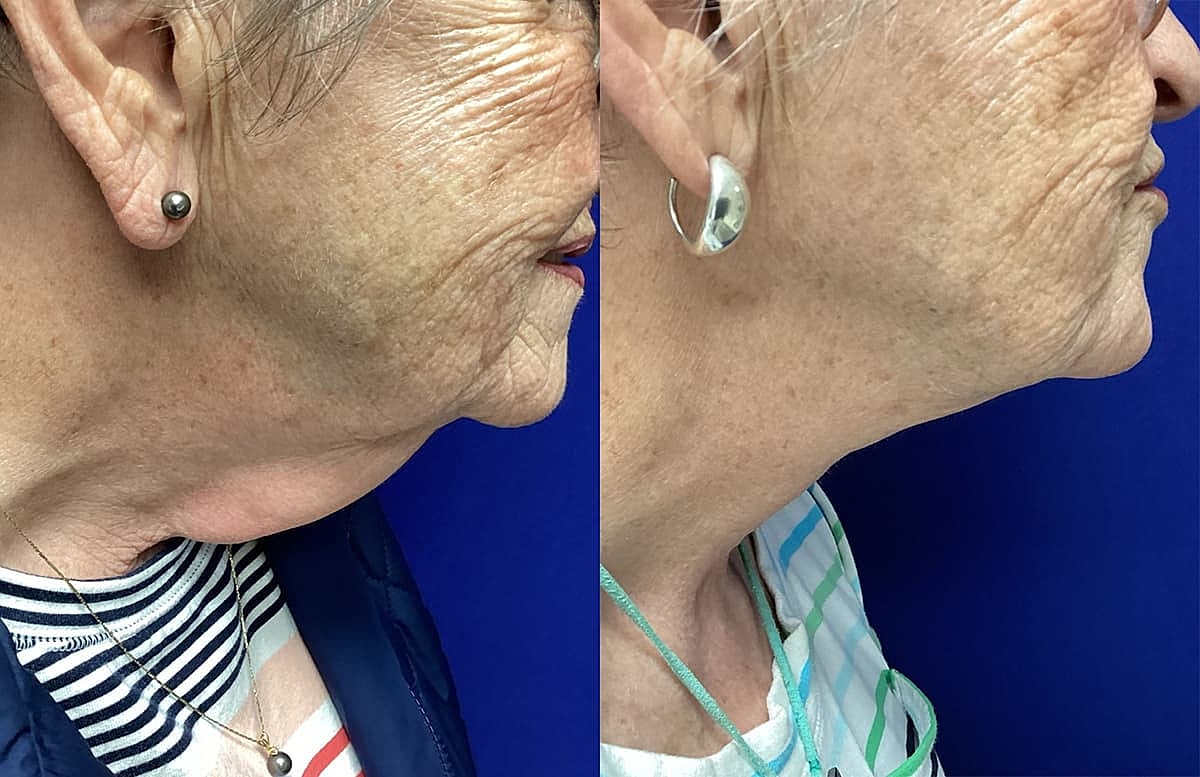 Before and after profile of older woman's face