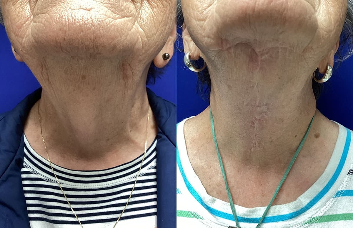 Before and after neck skin appearance comparison.