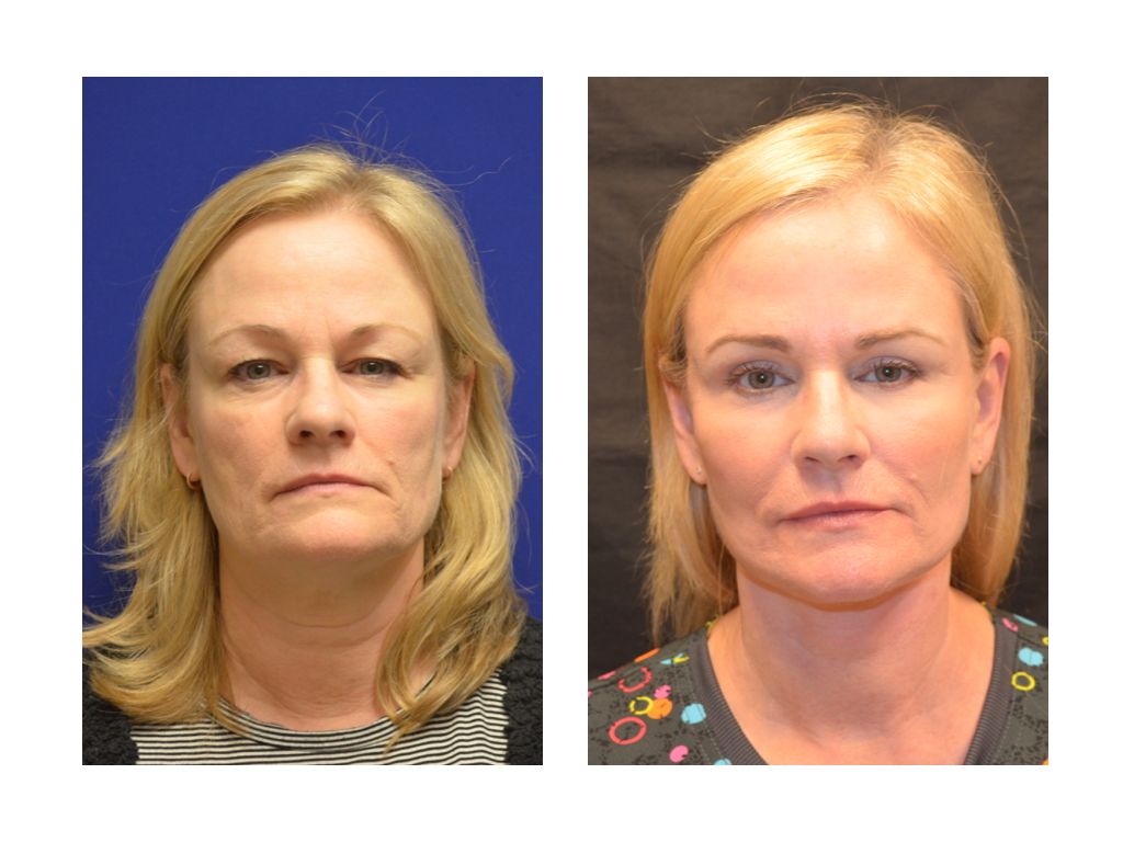 Facelift Before & After