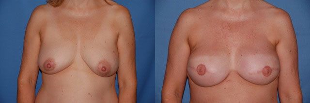 Breast Reconstruction Before & After