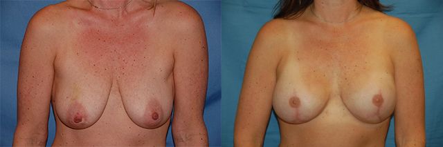 Breast Reconstruction Before & After