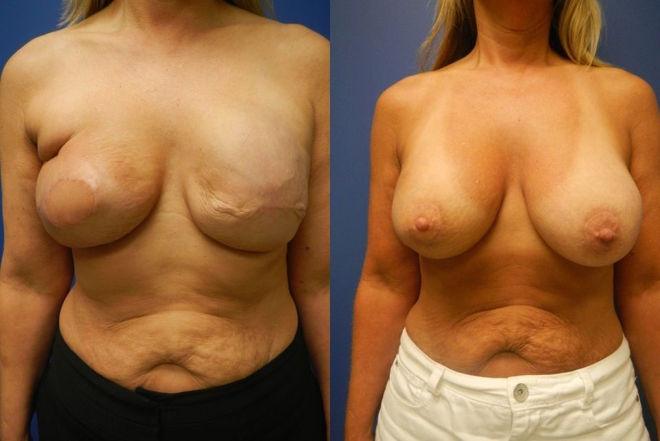 Breast Reconstruction Before & After