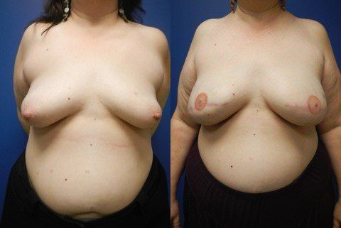 Breast Reconstruction Before & After