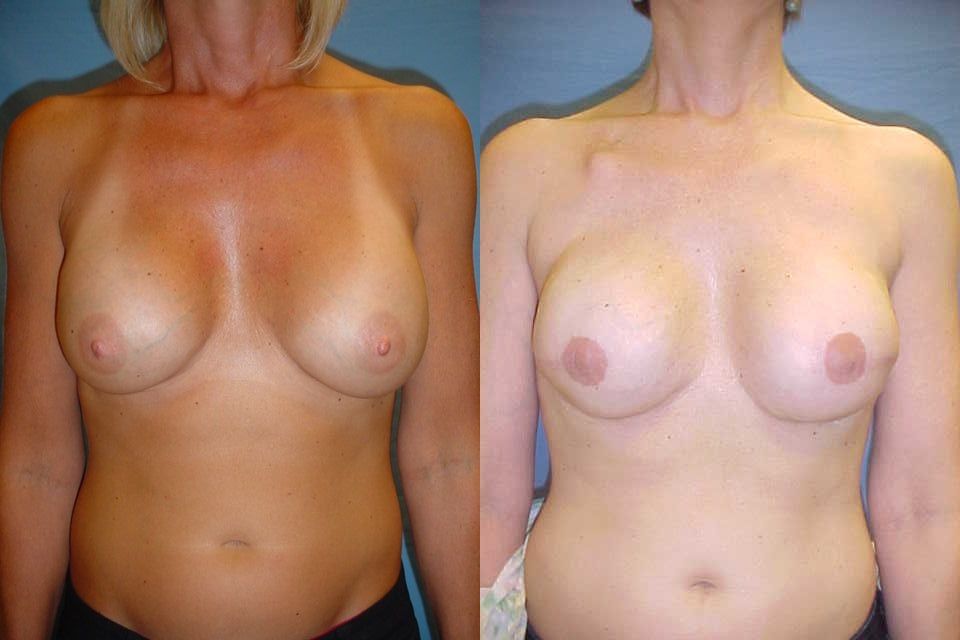 Breast Reconstruction Before & After