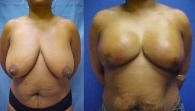 Breast Reconstruction Before & After