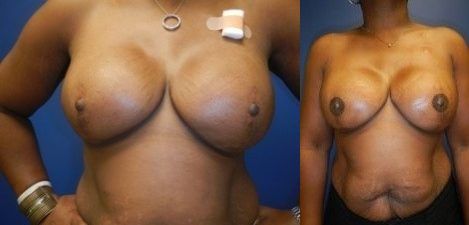 Breast Reconstruction Before & After