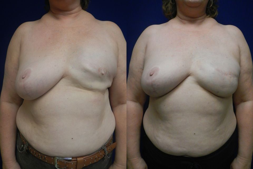 Breast Reconstruction Before & After