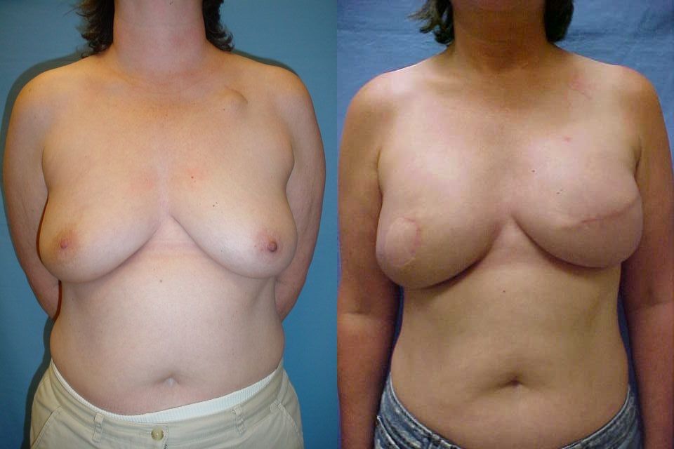Breast Reconstruction Before & After