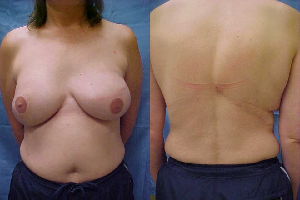 Breast Reconstruction Before & After