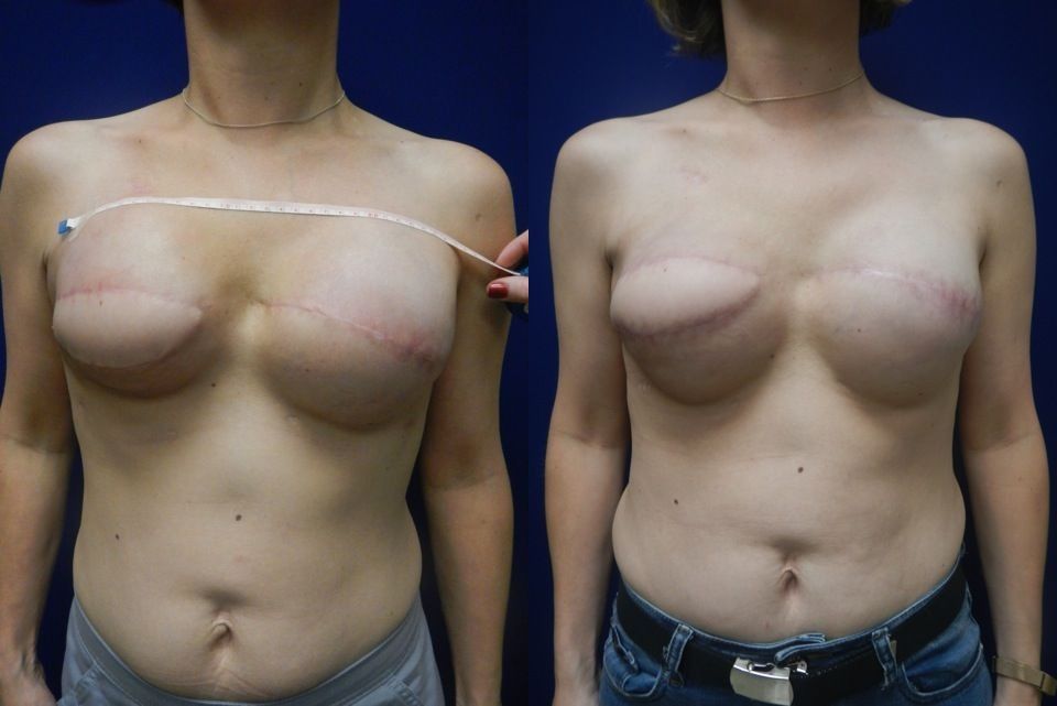 Breast Reconstruction Before & After