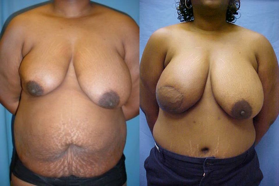 Breast Reconstruction Before & After
