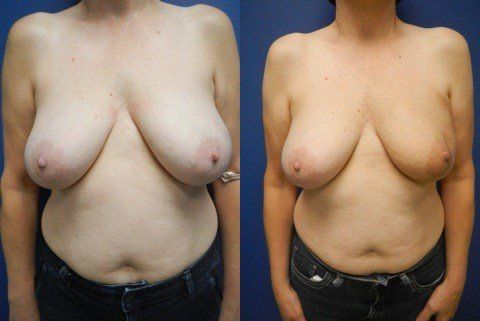 Breast Reconstruction Before & After