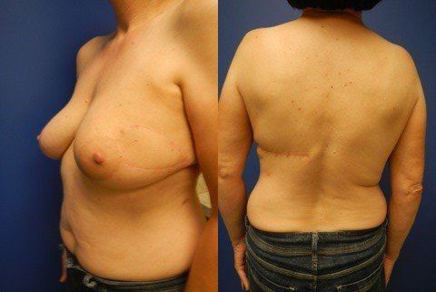 Breast Reconstruction Before & After