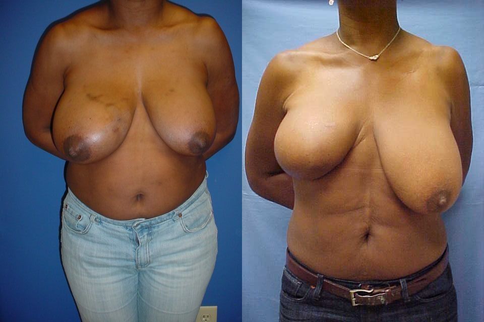 Breast Reconstruction Before & After