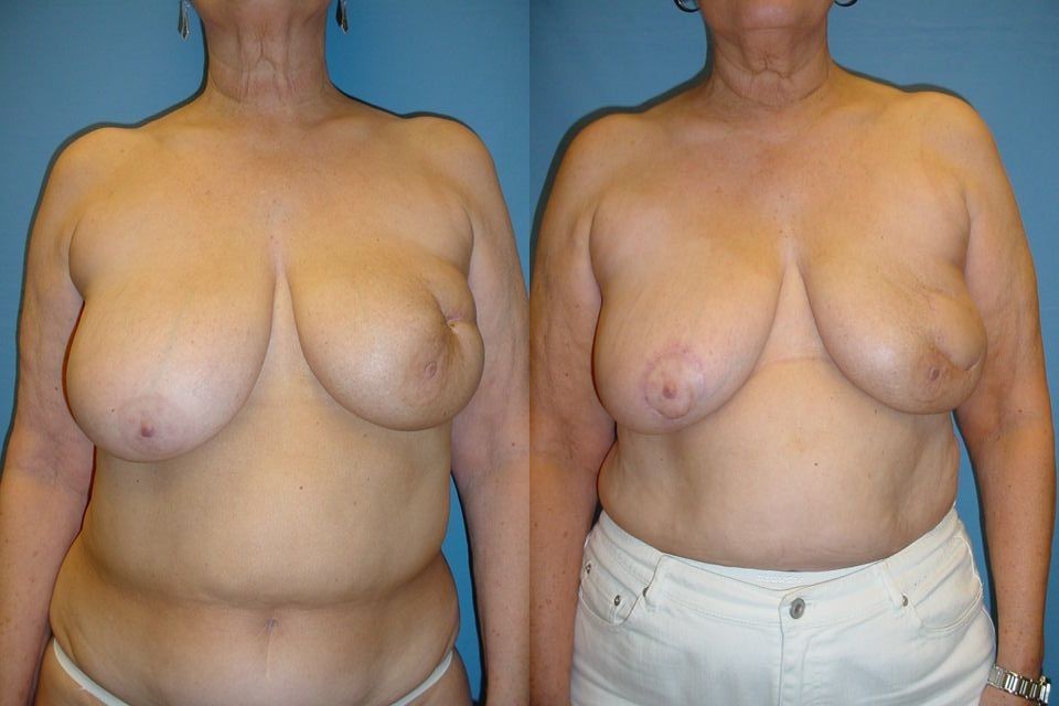 Breast Reconstruction Before & After